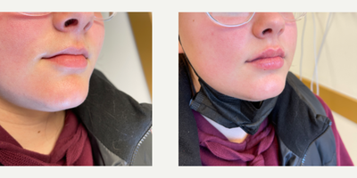 Dermal Fillers before and after photo
