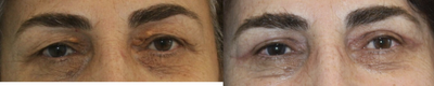 Eyelid Surgery before and after photo