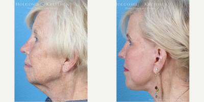 Neck Lift before and after photo