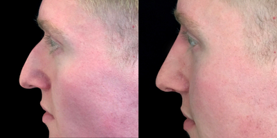 Nonsurgical Nose Job before and after photo