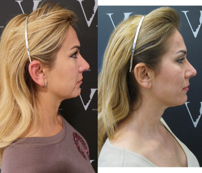 Aqualyx before and after photo