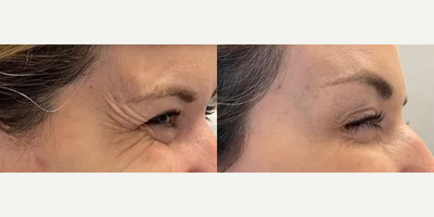 Botox before and after photo