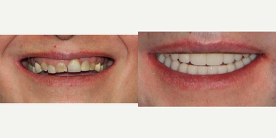 Dental Implants before and after photo