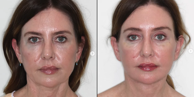 Facelift before and after photo