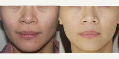 Microneedling before and after photo