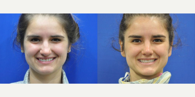 Revision Rhinoplasty before and after photo