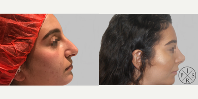 Rhinoplasty before and after photo