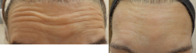 Xeomin before and after photo
