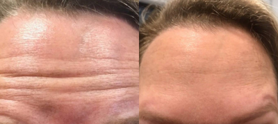 Botox before and after photo