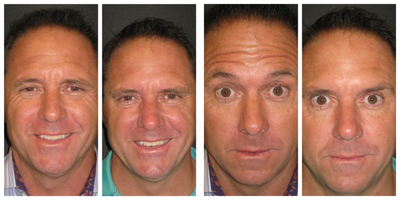 Botox before and after photo
