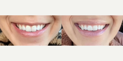 Botox before and after photo