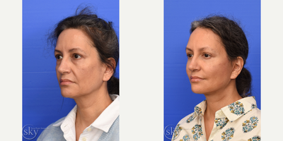Deep Plane Facelift before and after photo