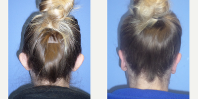 Ear Surgery before and after photo