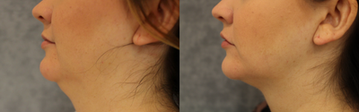 FaceTite before and after photo