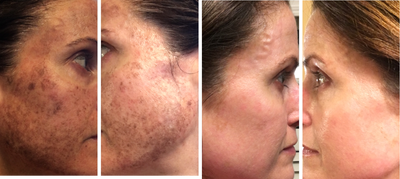IPL before and after photo