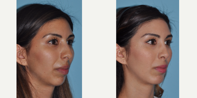 Rhinoplasty before and after photo