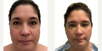 Rhinoplasty before and after photo