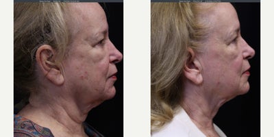 CO2 Laser before and after photo