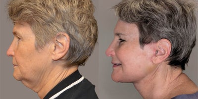 Deep Plane Facelift before and after photo
