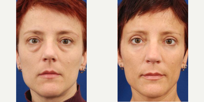Eyelid Surgery before and after photo