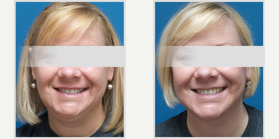 Facelift before and after photo