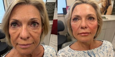 Liquid Facelift before and after photo
