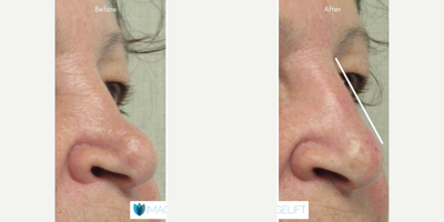 Radiesse before and after photo