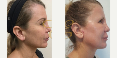 Laser Resurfacing before and after photo