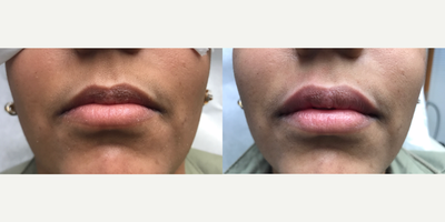 Lip Fillers before and after photo