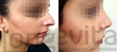 Rhinoplasty before and after photo