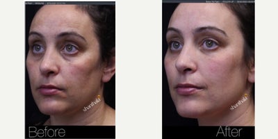 Clear and Brilliant before and after photo