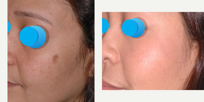 Laser Resurfacing before and after photo