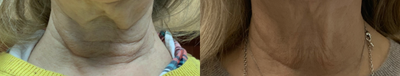 Microneedling RF before and after photo