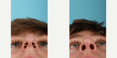 Rhinoplasty before and after photo