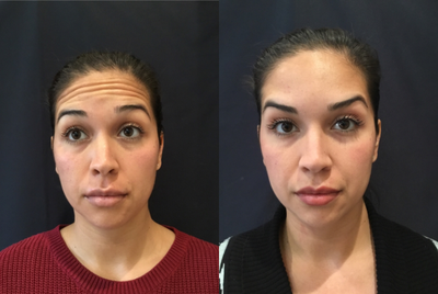 Dysport before and after photo