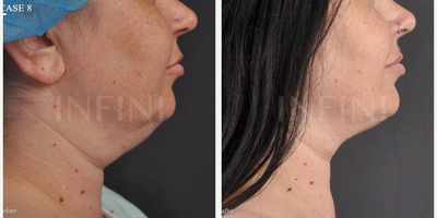 Skin Tightening before and after photo