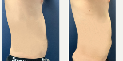 SlimLipo before and after photo