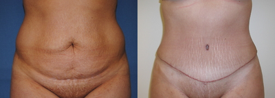 Tummy Tuck before and after photo
