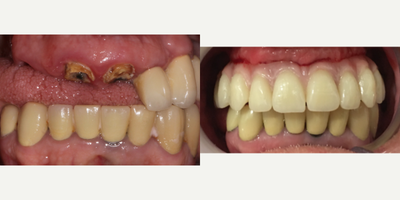 All-on-4 Dental Implants before and after photo