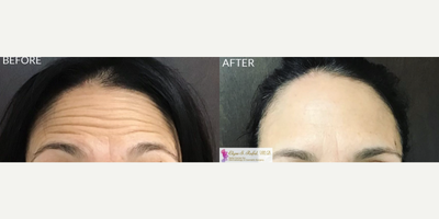 Botox before and after photo