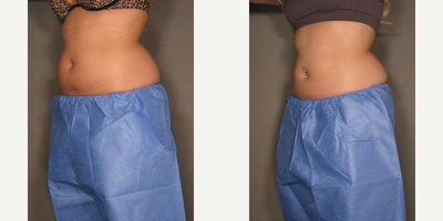 CoolSculpting before and after photo