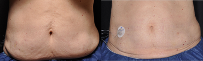 CoolSculpting before and after photo