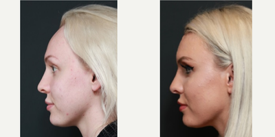 Forehead Reduction before and after photo