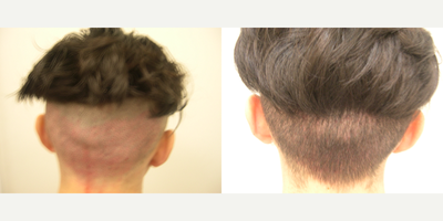 Hair Transplant before and after photo