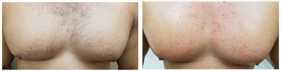 Laser Hair Removal before and after photo