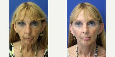 Cheek Augmentation before and after photo