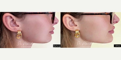 Chin Filler before and after photo
