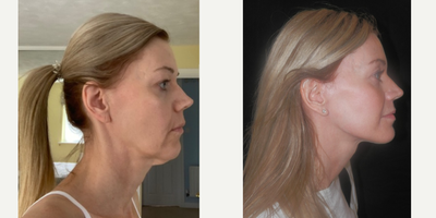 Facelift before and after photo