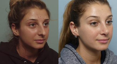 Rhinoplasty before and after photo
