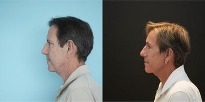 Deep Plane Facelift before and after photo